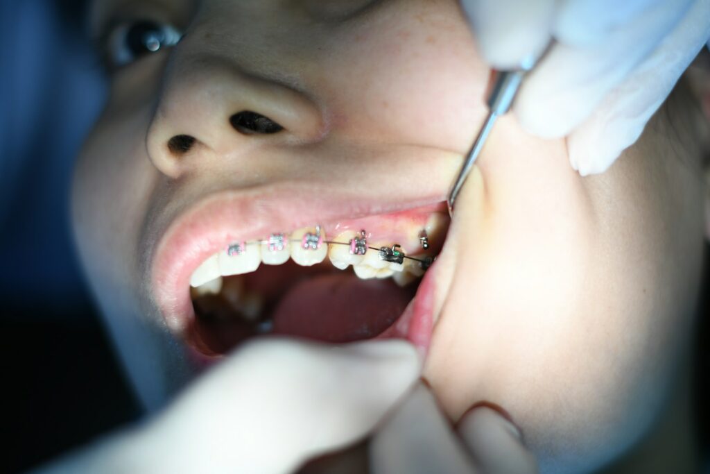 person with silver teeth braces||