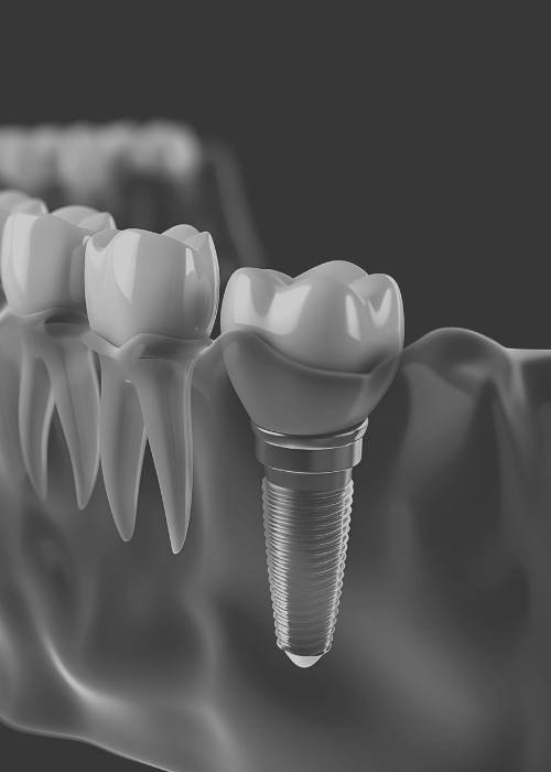Model implantu zastępującego brakujący ząb